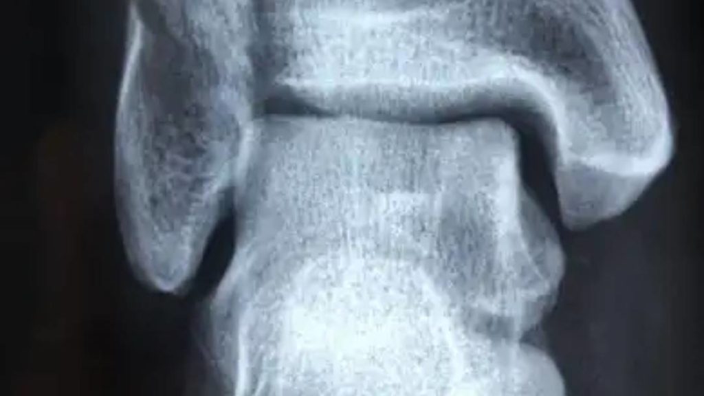 An x-ray of an ankle